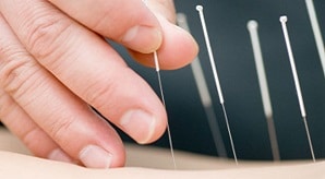 acupuncture brisbane north