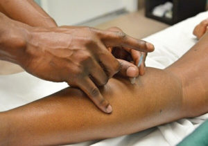 acupuncture for sciatica